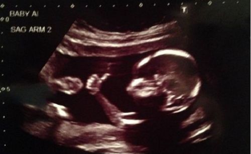 Florida Supreme Court Rules 15-Week Abortion Ban Can Keep Saving Babies