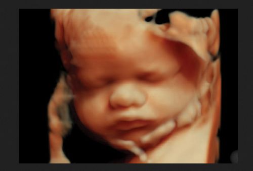 New Estimate Shows More Than 1 Million Babies Killed in Abortions in 2023